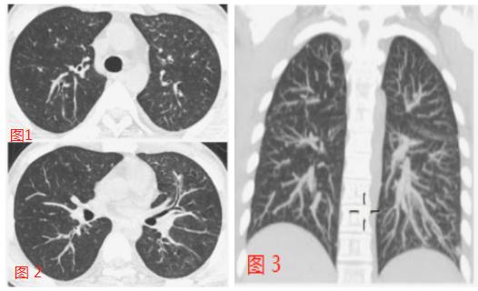 肺炎最新特点概述